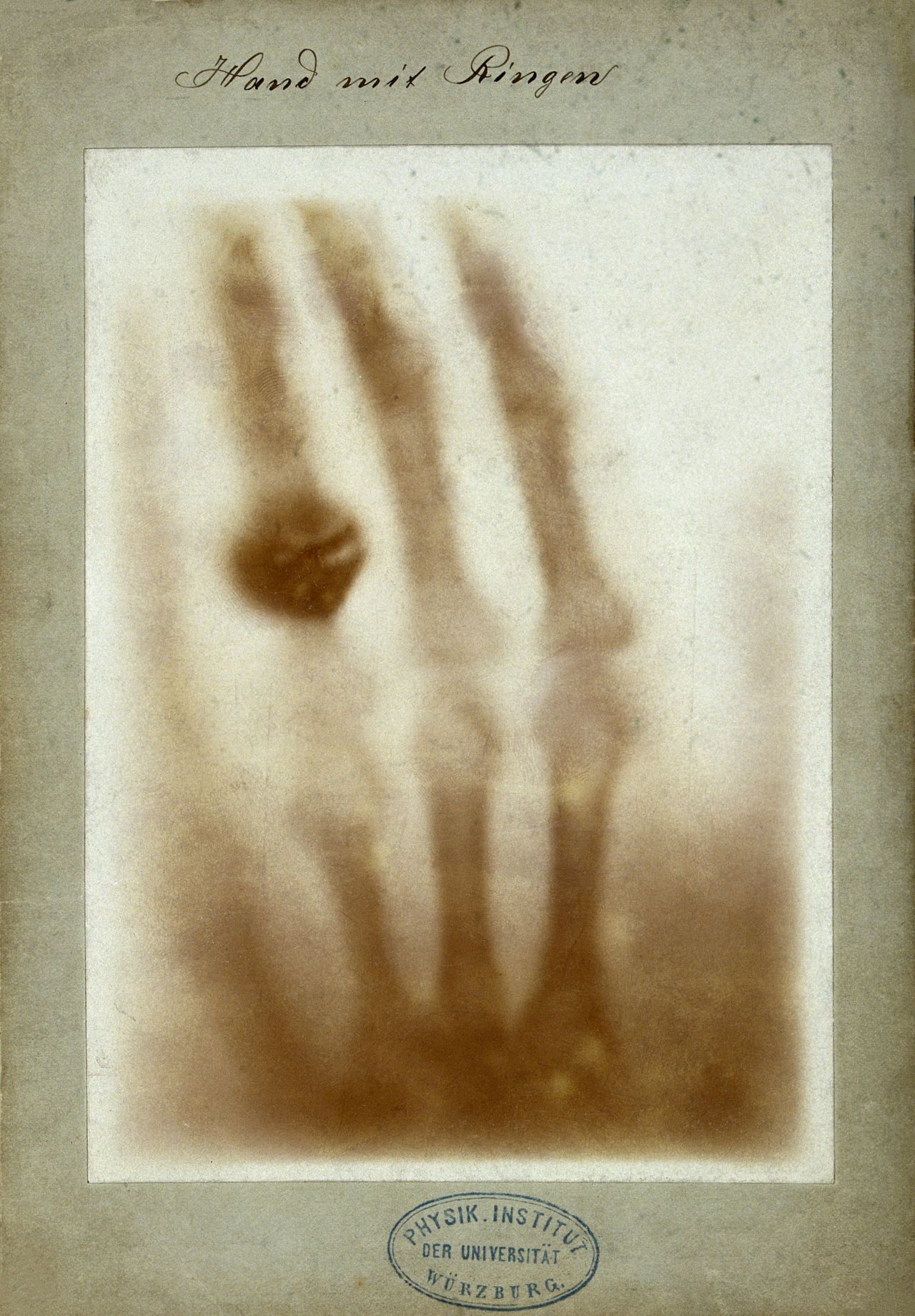 Wilhelm Röntgen's 1895 X-ray of his wife's hand, showing the finger bones and a dark wedding ring